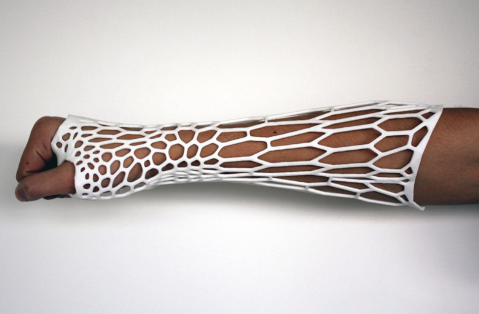 White 3D printed arm cast created using parametric modeling, featuring a ventilated lattice design for lightweight fracture support